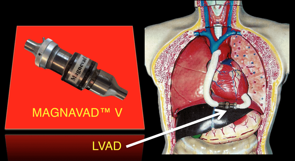 Goldowsky's LVAD heart pump SCAM - Image of the Magnevad Heart Pump LVAD and torso implantation illustration